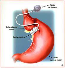 Cirurgia de redução de estômago pode ter efeito cascata